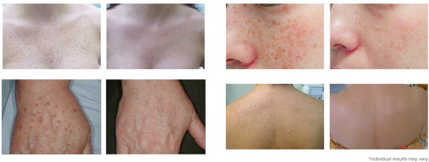 redspots-pigmentation-beforeafter