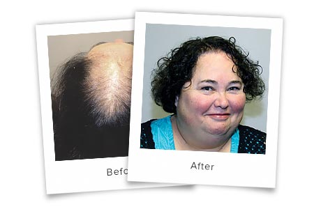 FemalePatternHairLoss-Image1